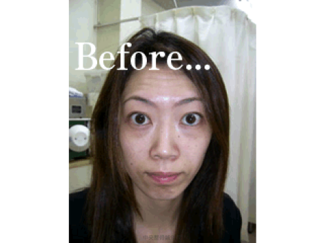 美容鍼施術前 Before 美容鍼施術前 Before